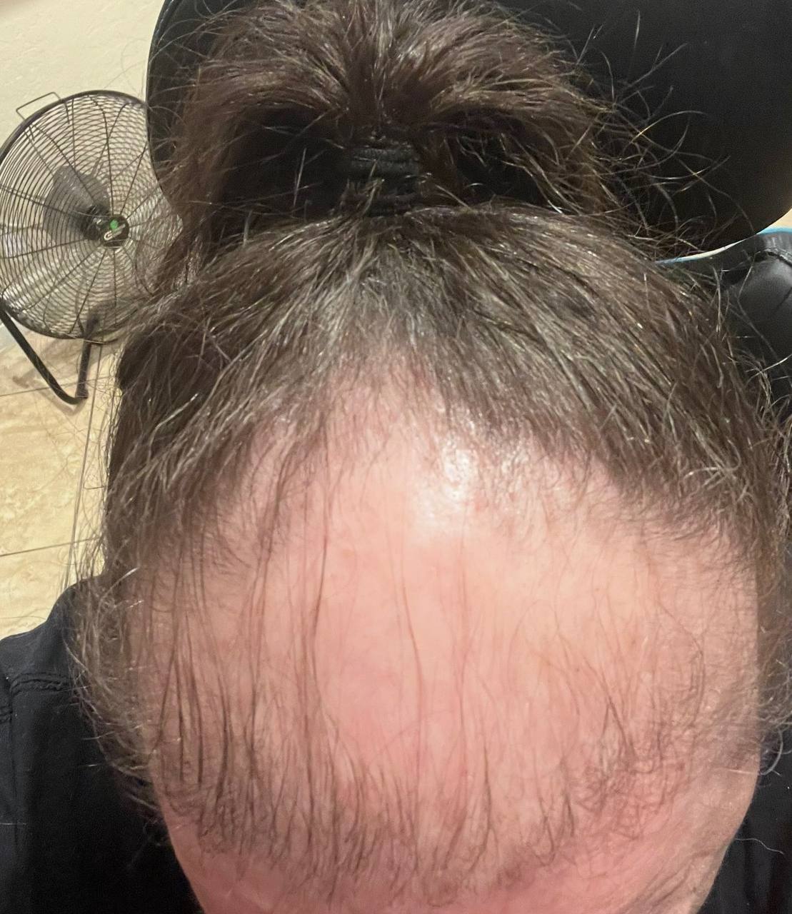 Before — thinning at the crown