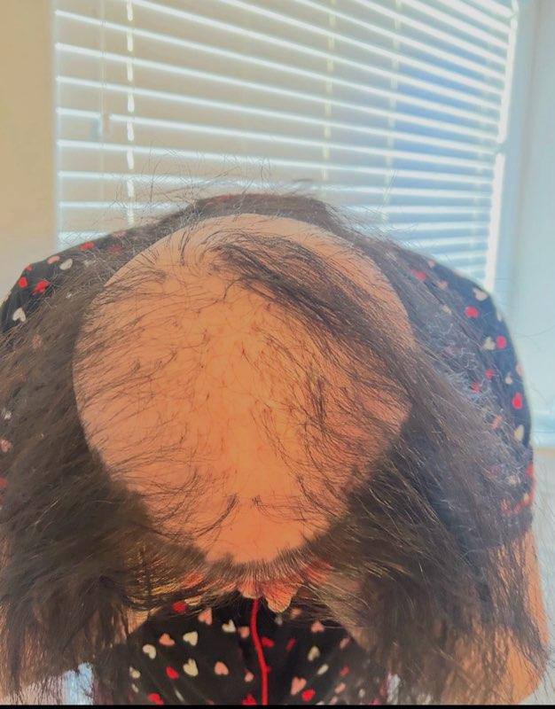 Before — significant thinning at the crown