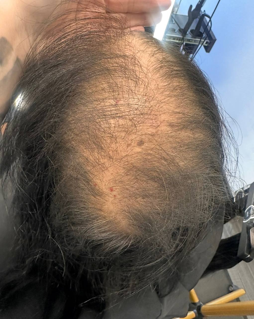 Before — significant crown thinning