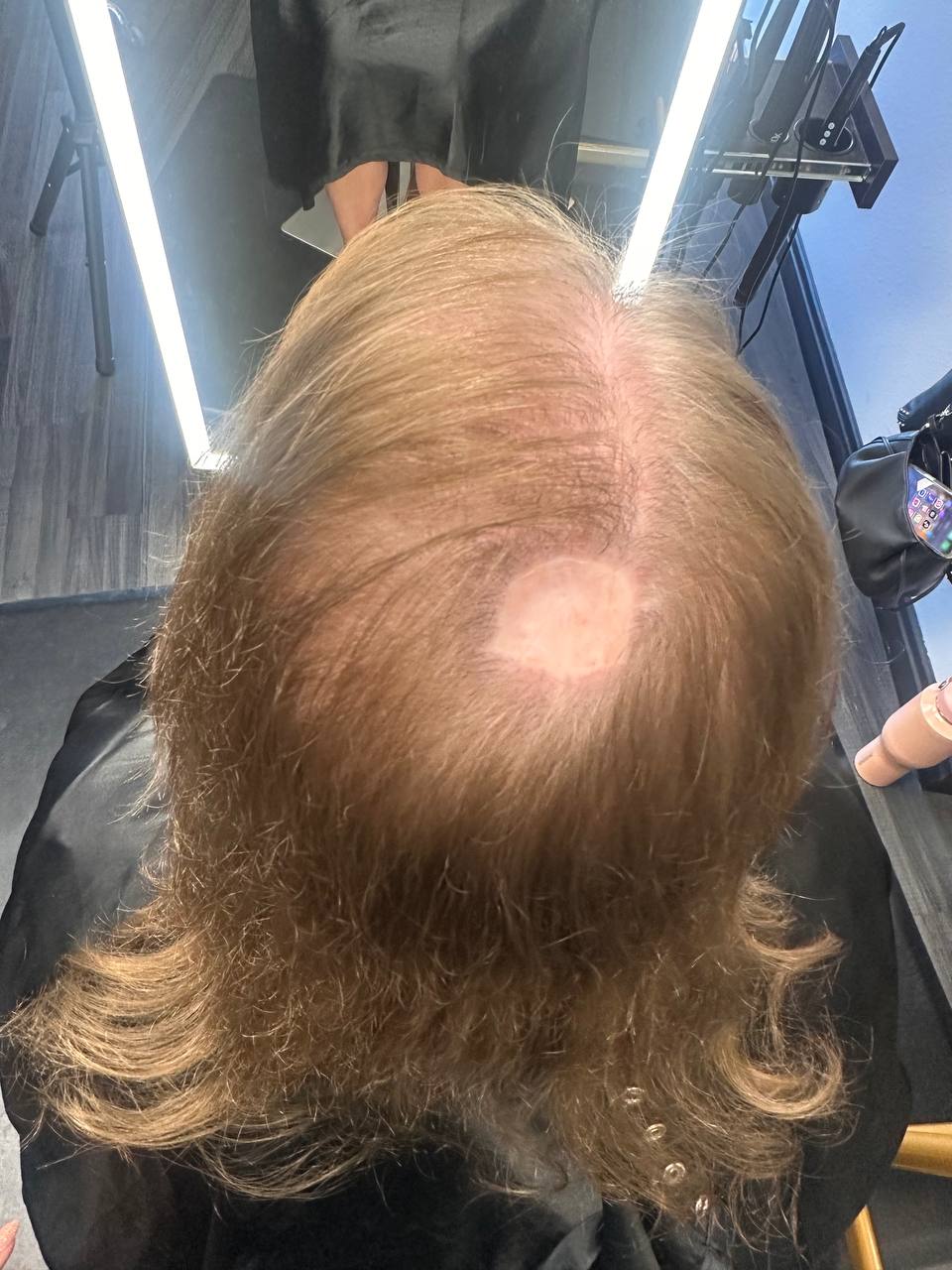Before — blonde hair with thinning bald spot at crown