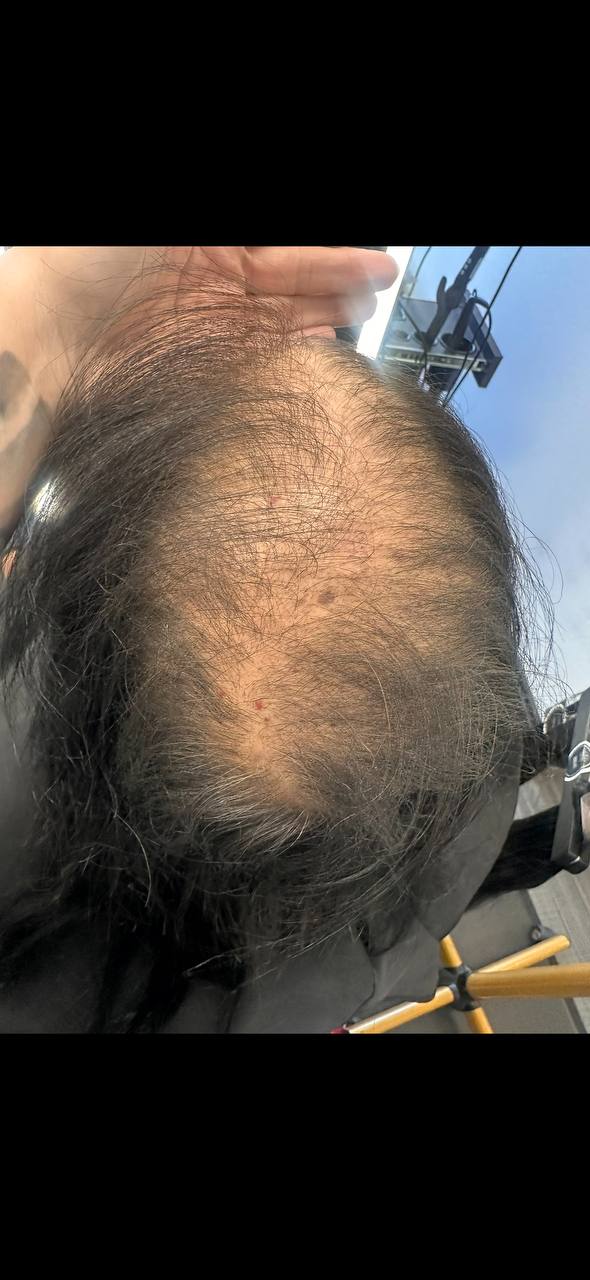 Before — severe crown thinning, dark hair
