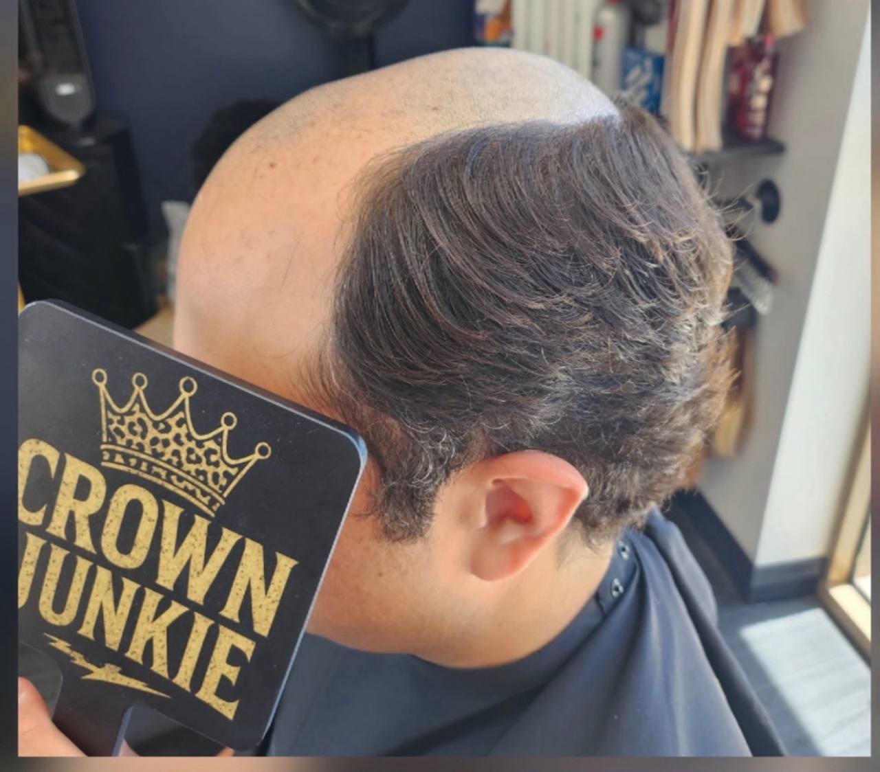 Before — men's hair loss at the crown
